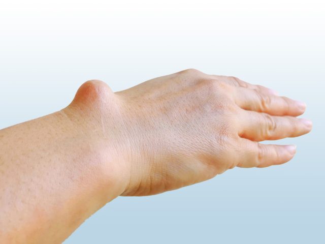 Que révèle une petite boule sous la peau douloureuse au toucher ?