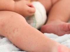 Comment reconnaître les boutons de chaleur ? Photos et conseils pratiques. Comment reconnaître les boutons de chaleur ? Photos et conseils pratiques.