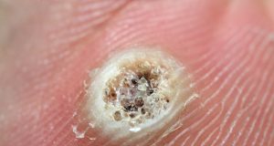 Comment reconnaître une verrue morte : signes et symptômes à surveiller ? Comment reconnaître une verrue morte : signes et symptômes à surveiller ?