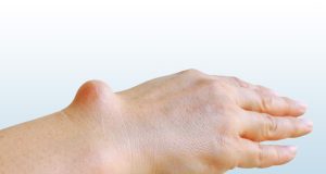 Que révèle une petite boule sous la peau douloureuse au toucher ? Que révèle une petite boule sous la peau douloureuse au toucher ?