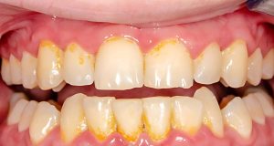 Comment enlever efficacement le tartre des dents chez soi ? Comment enlever efficacement le tartre des dents chez soi ?