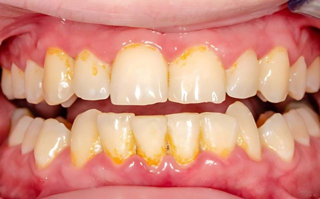 Comment enlever efficacement le tartre des dents chez soi ?